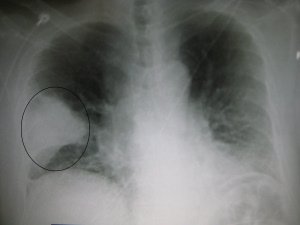 lingering bronchitis or something worse?.