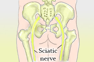 Exercises To Improve Sciatica Pain - Home Treatment for Sciatica