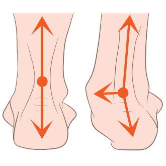 Over-Pronation