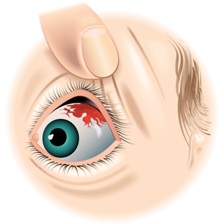 What causes broken blood vessels in eyes?