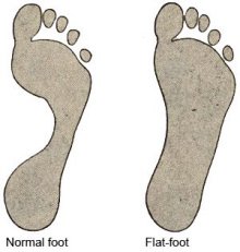 Flat footed meaning