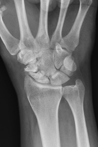 Wrist Fracture Symptoms | HealthGuidance