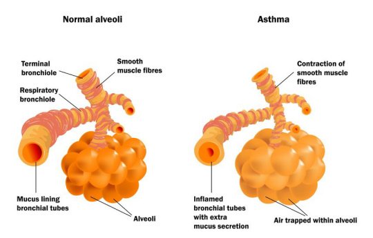 Similarities and Differences Between Asthma and Allergies