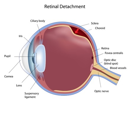 What Is A Detached Retina Healthguidance