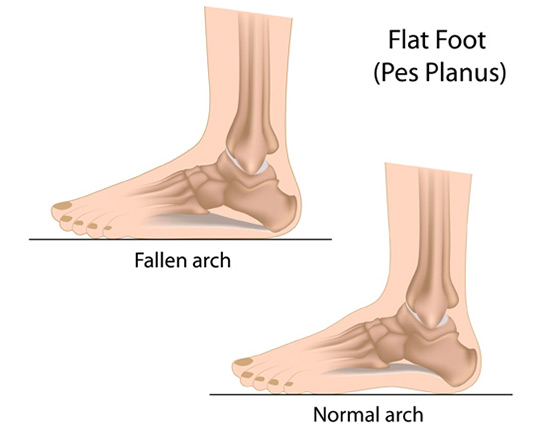 How To Tell If You Are Flat Footed : How to tell if you are flat footed.
