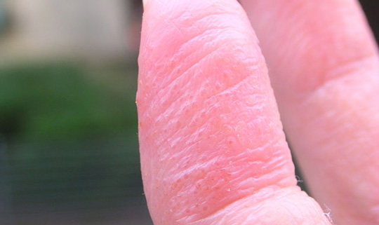What Is Dyshidrosis? What Is Dyshidrosis?