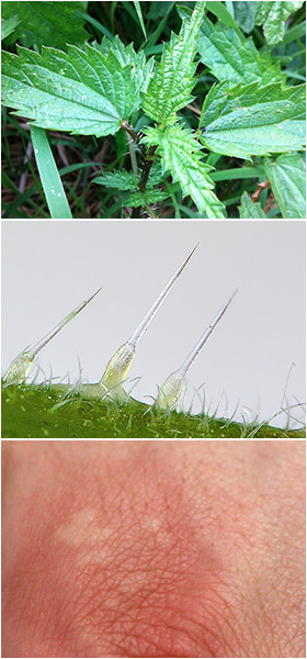 What Happens When You Get Stung by a Nettle – And How to Treat It