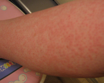 Hives (Urticaria) Treatment, Symptoms, Signs & Pictures